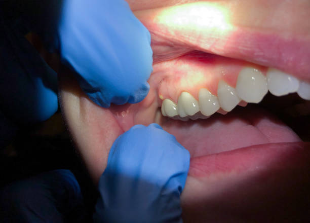 Best Emergency Cosmetic Dentistry (e.g., broken veneers) in Beaver Creek, TX